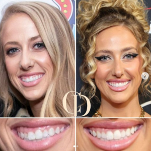 brittany mahomes teeth and face surgery